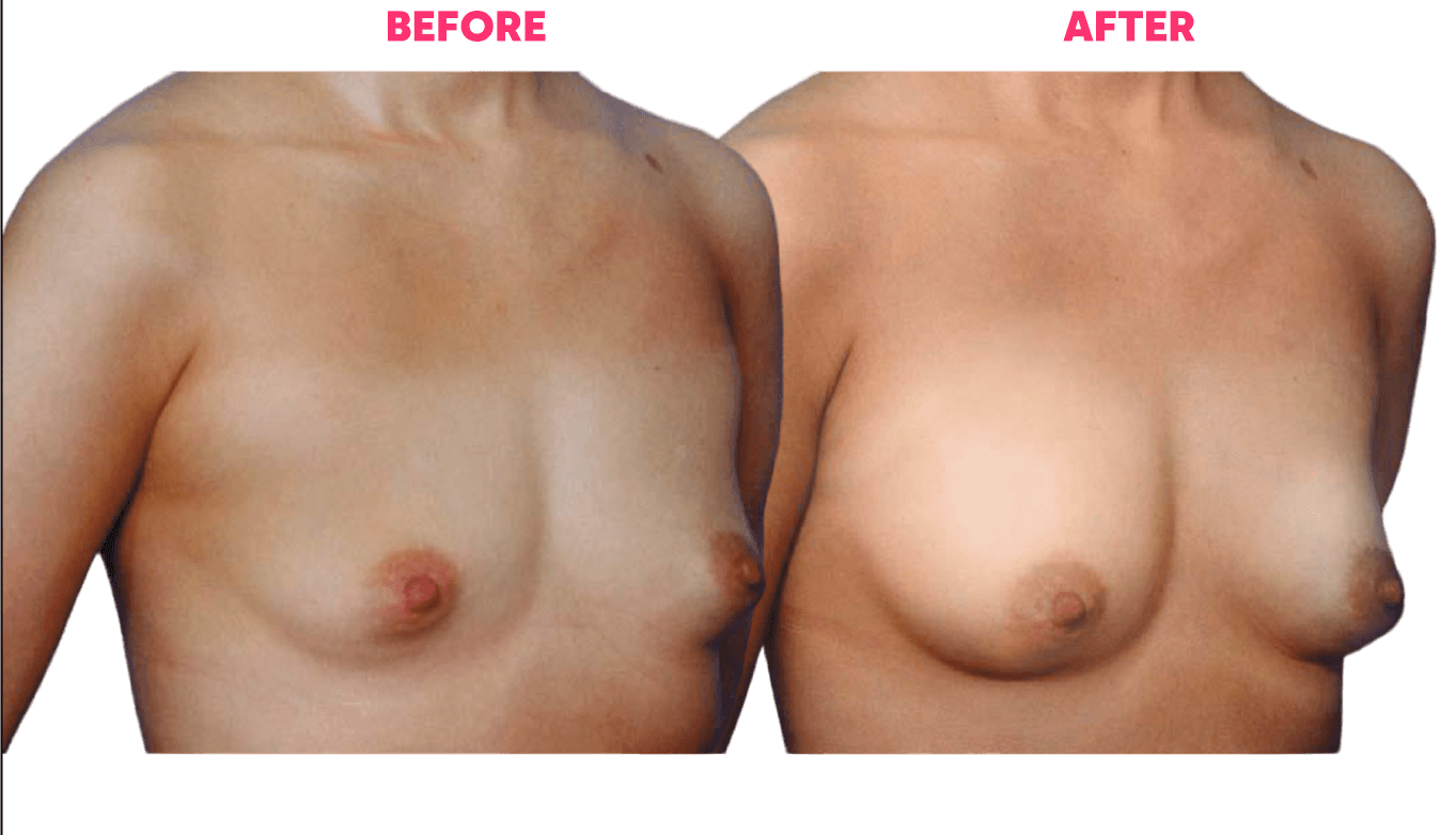 Breast Enlargement Pump Before and After