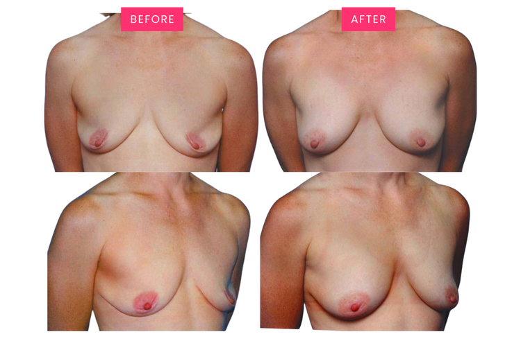 Original before-and-after comparison, image two