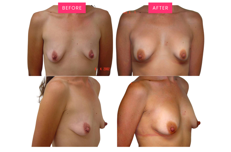 Original before-and-after comparison, image five