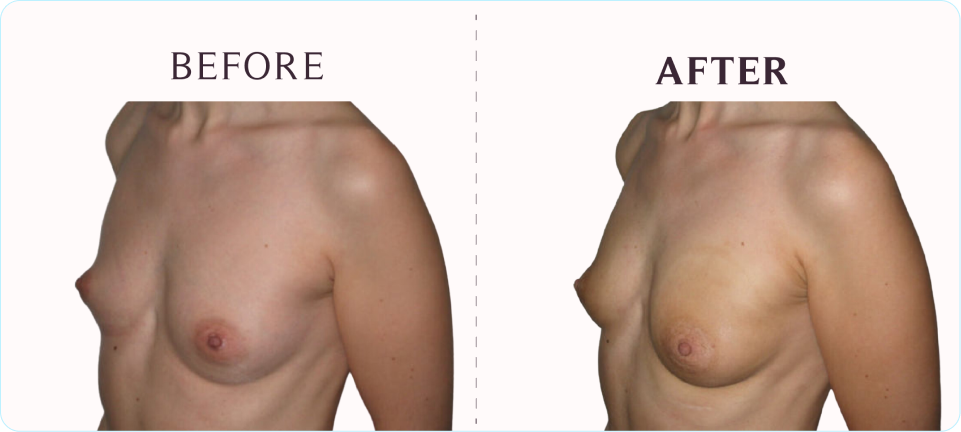 EVEBRA  Nonsurgical Natural Breast Enlargement Pump – EveBra