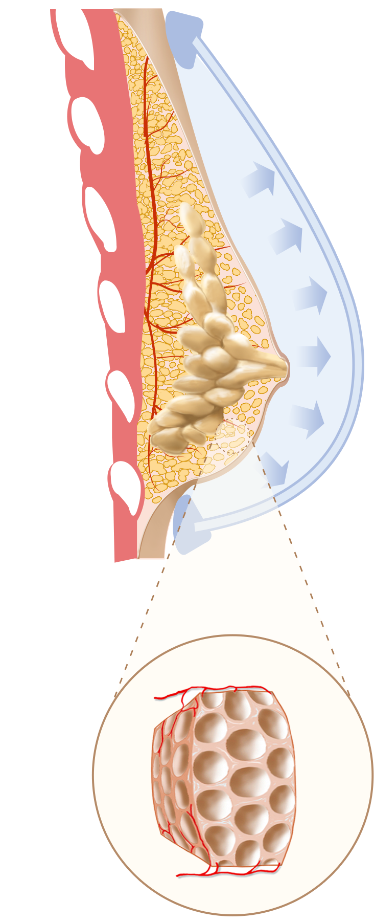Original EVEBRA stage two illustration showing early outward tissue expansion