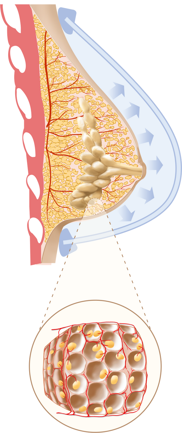 EVEBRA stage three — continued external tissue expansion, weeks 10 to 20
