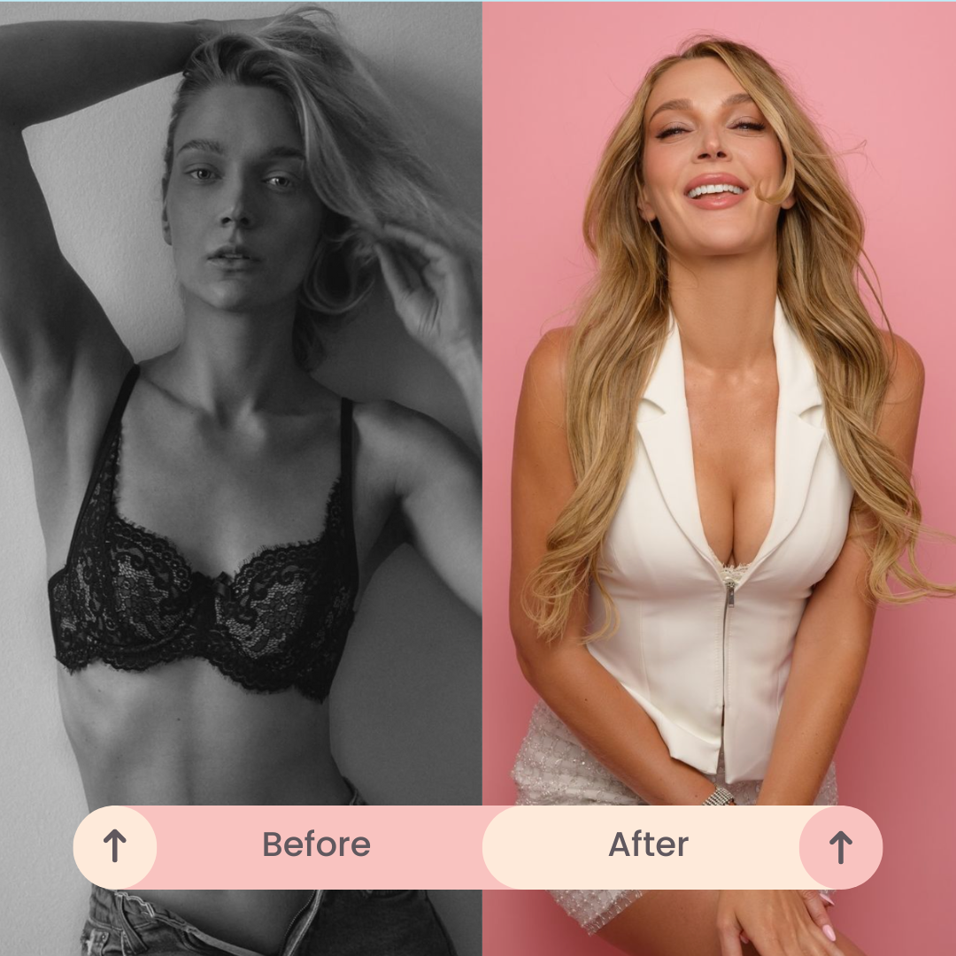 EVEBRA Model Before and After Natural Breast Enlargement