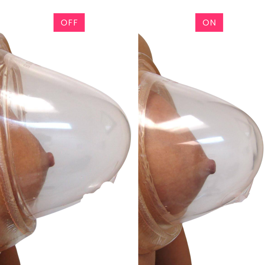 Original EVEBRA pump-off and pump-on diagram showing tissue drawn into a clear dome