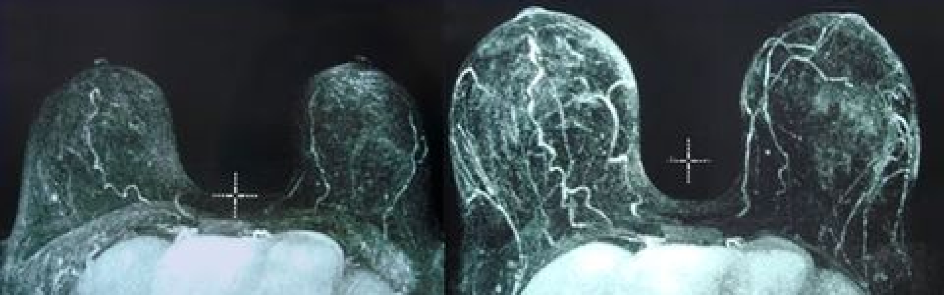 MRI Breast External Expander Before and After
