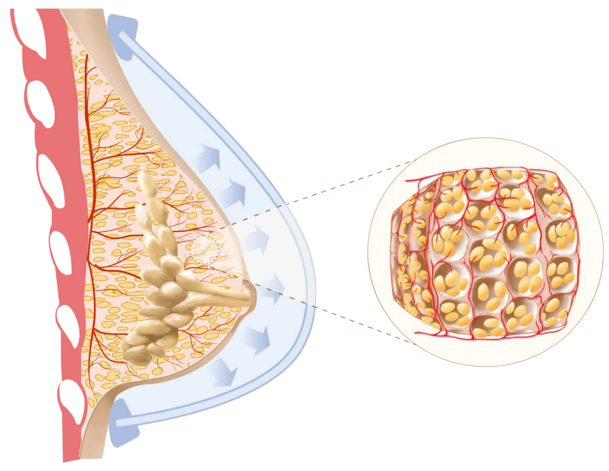 Original EVEBRA anatomical illustration of a breast in a dome under outward tension