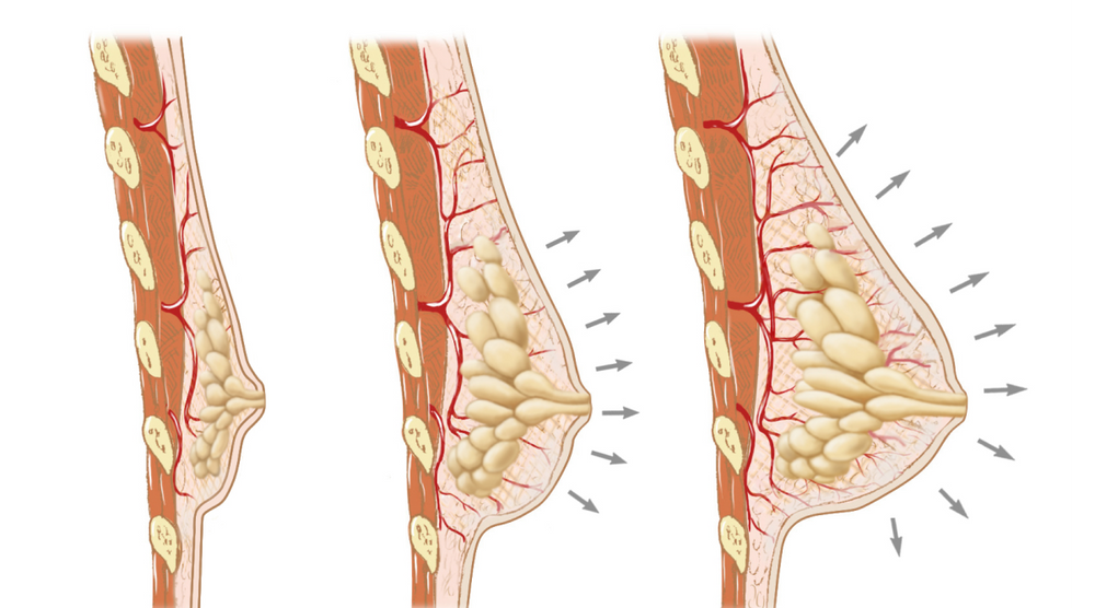 Original EVEBRA medical illustration of three breast cross-sections under outward tension