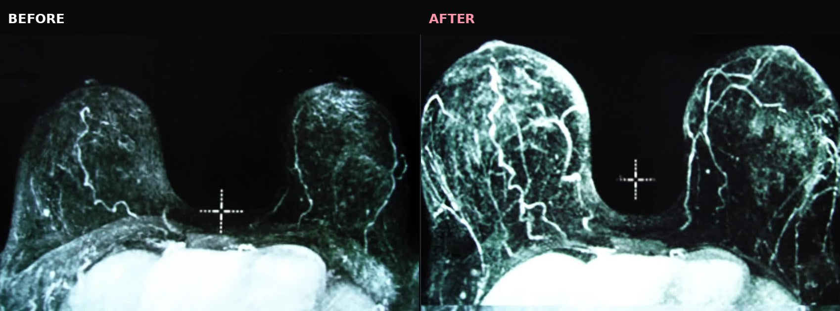 Research MRI comparing breast tissue before and after an external tissue expansion protocol