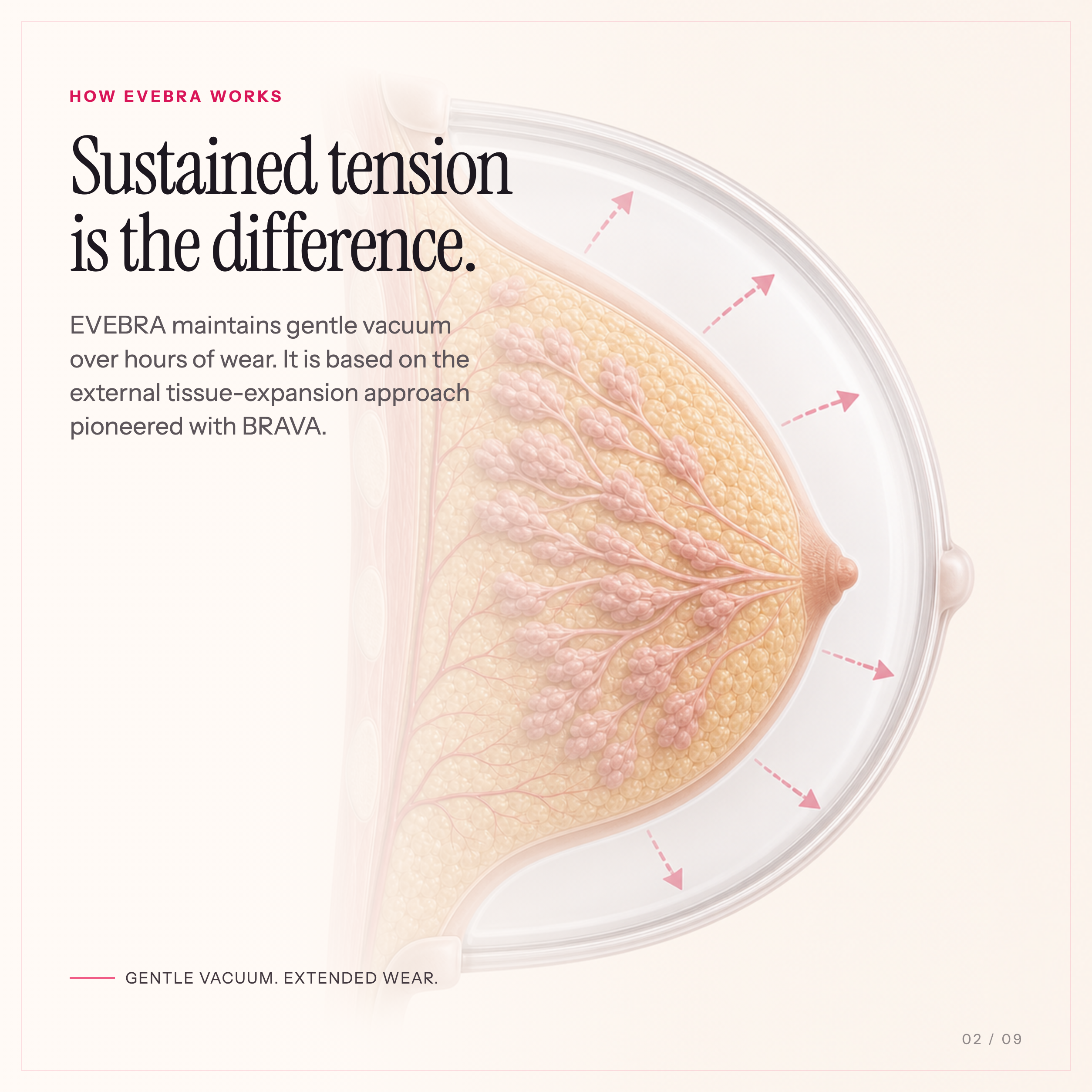 How EVEBRA uses sustained gentle vacuum tension for external breast tissue expansion