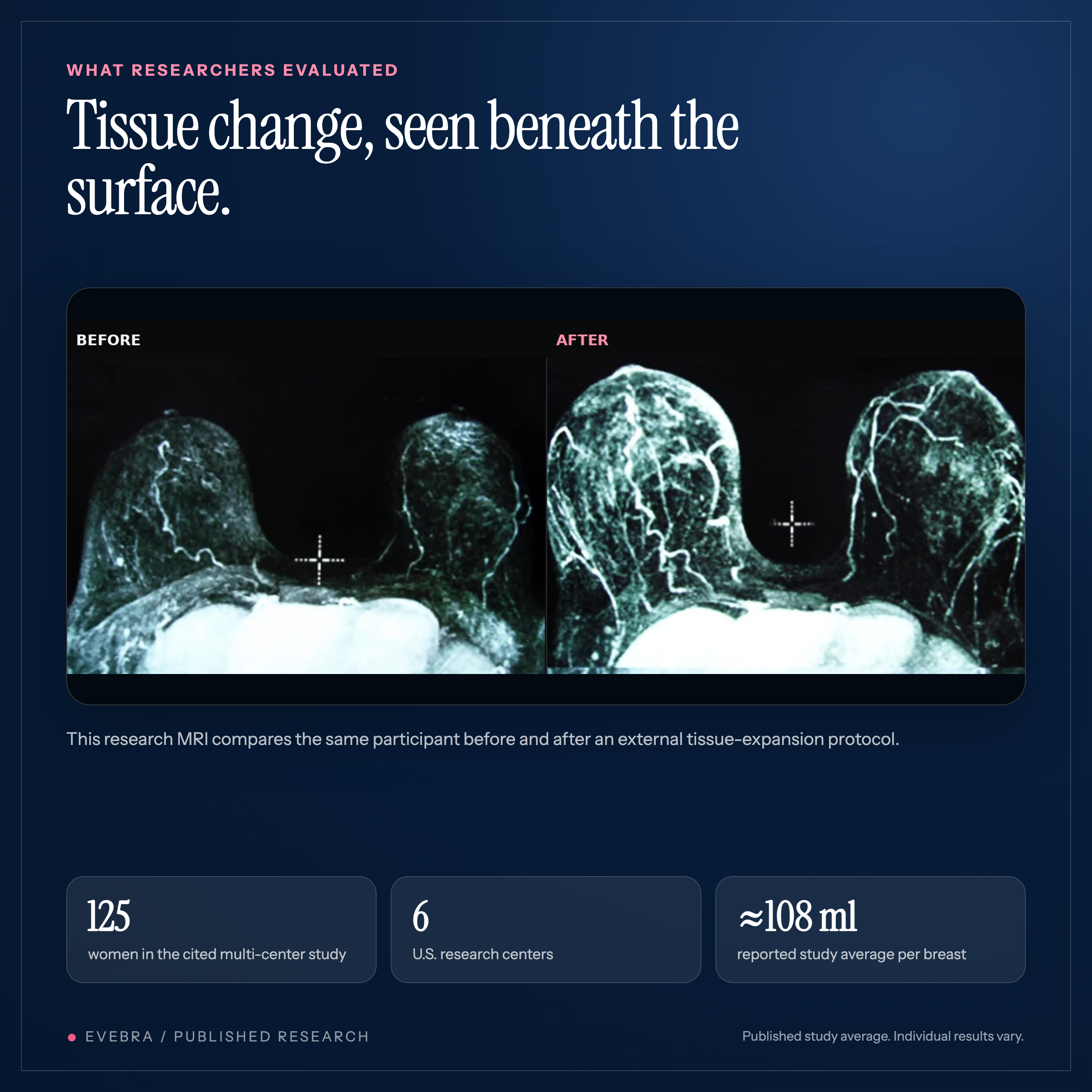 Research MRI showing breast tissue before and after external tissue expansion