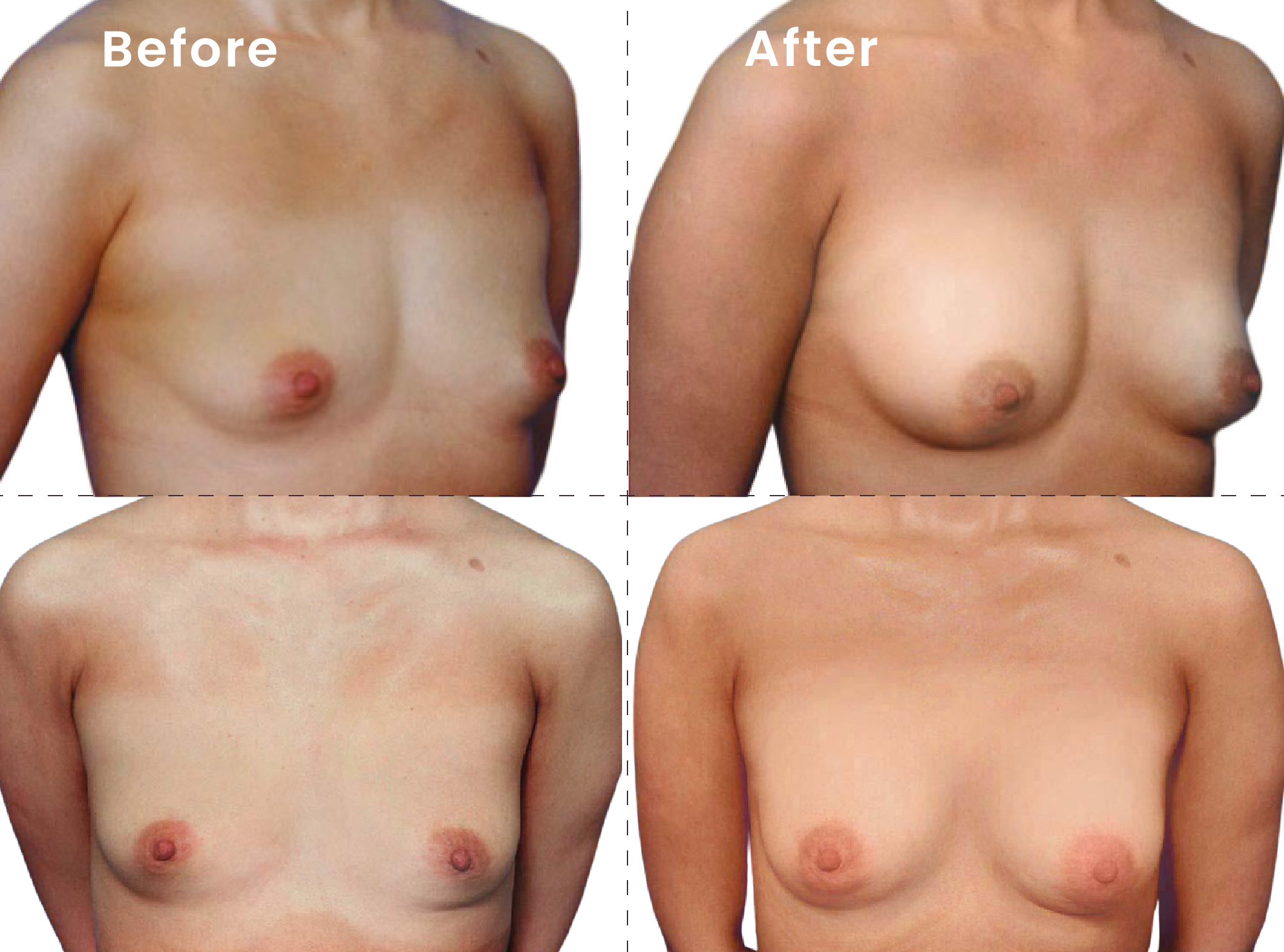 EVEBRA customer result 08 before and after external breast expansion, shown from front and angled views