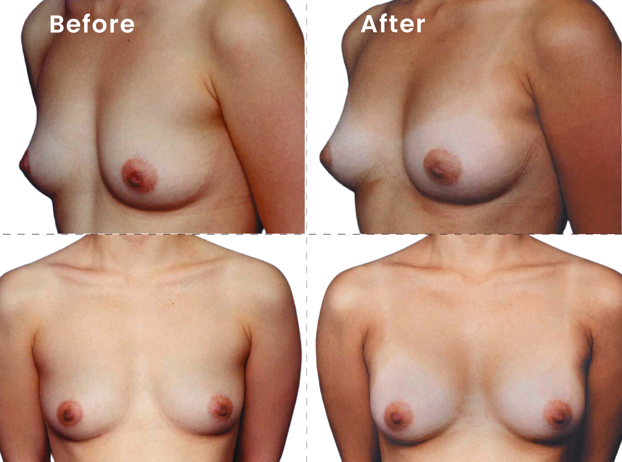 EVEBRA customer result 09 before and after external breast expansion, shown from front and angled views