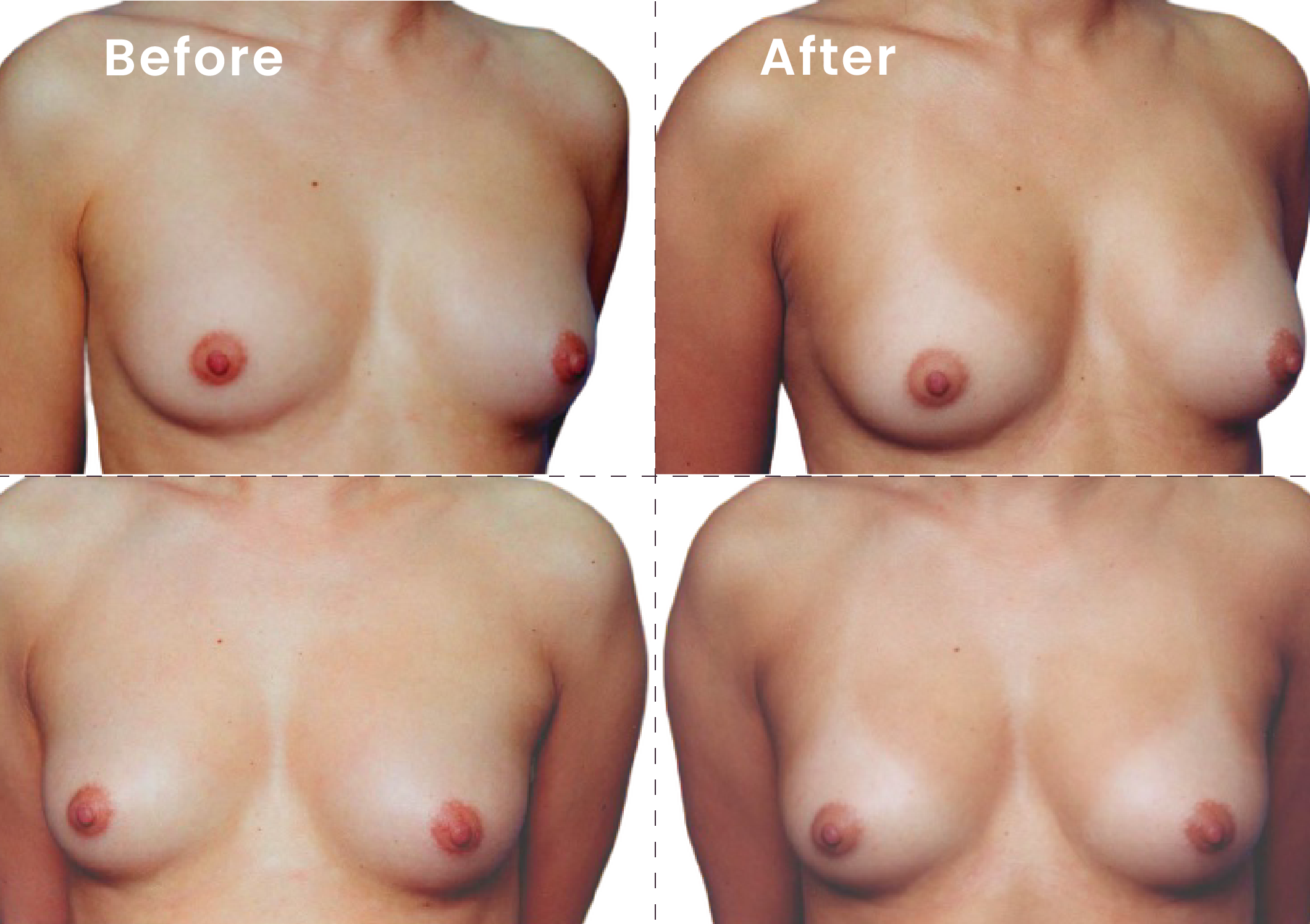 EVEBRA customer result 10 before and after external breast expansion, shown from front and angled views
