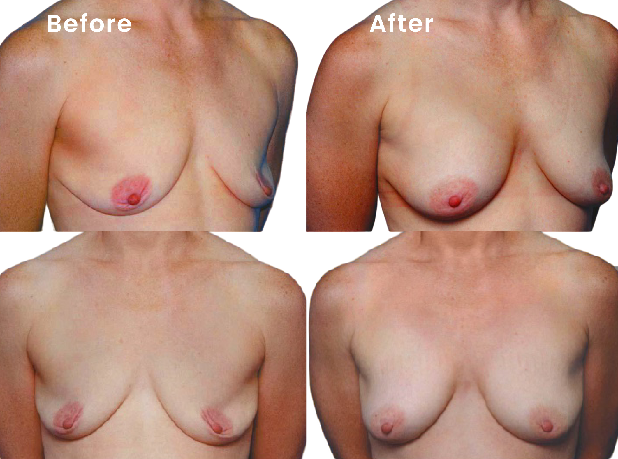 EVEBRA customer result 11 before and after external breast expansion, shown from front and angled views