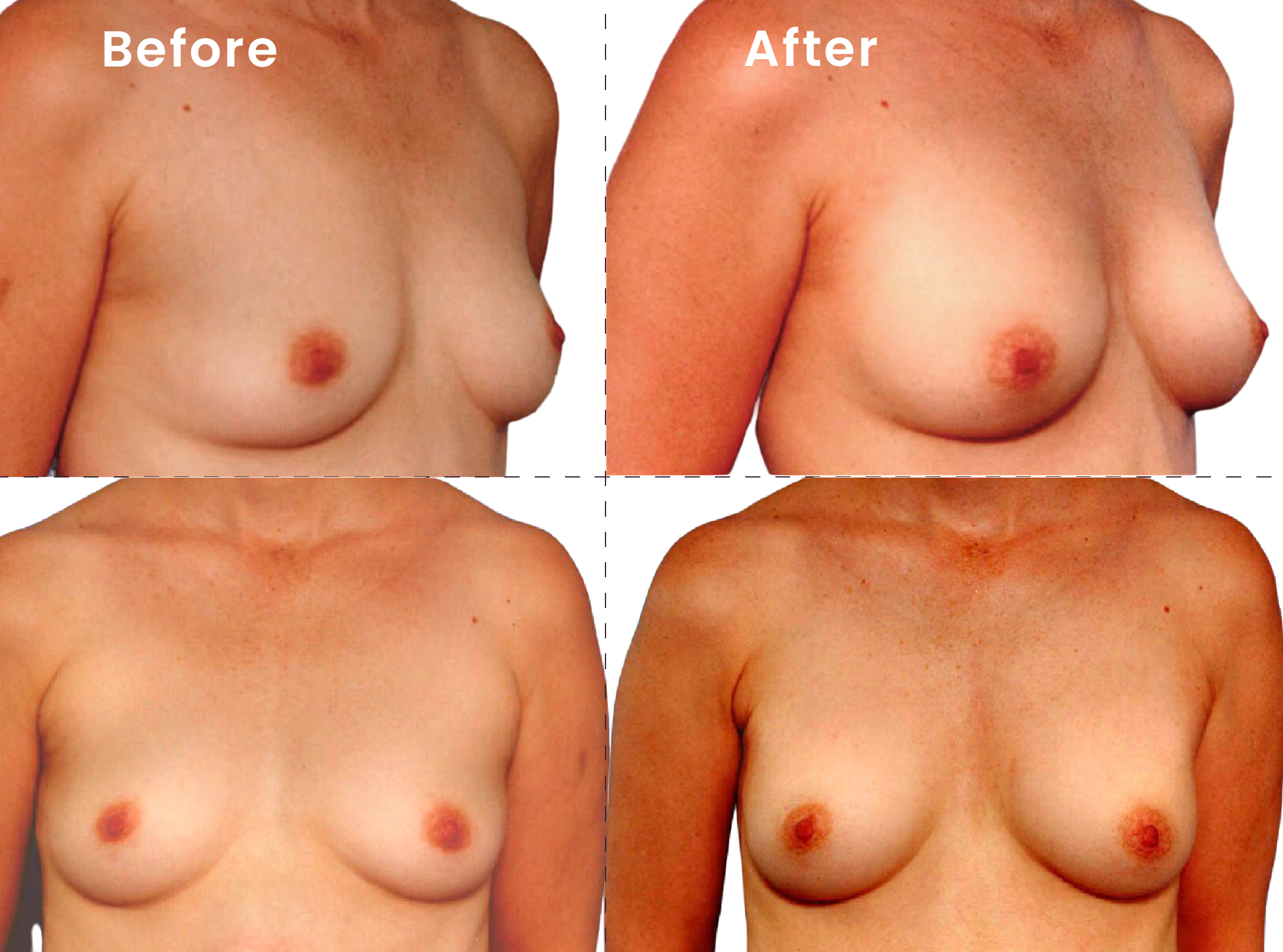 EVEBRA customer result 12 before and after external breast expansion, shown from front and angled views