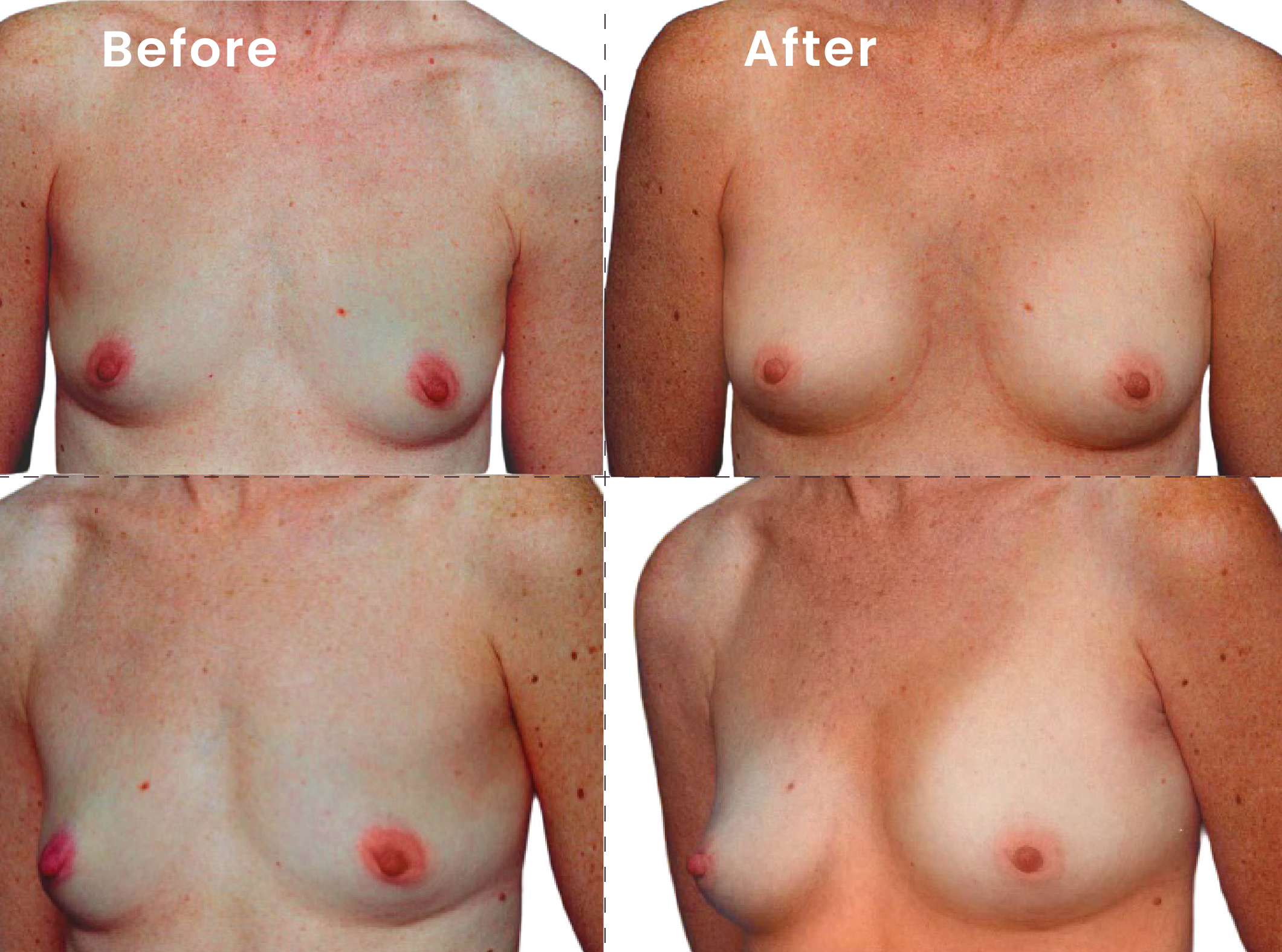 EVEBRA customer result 13 before and after external breast expansion, shown from front and angled views