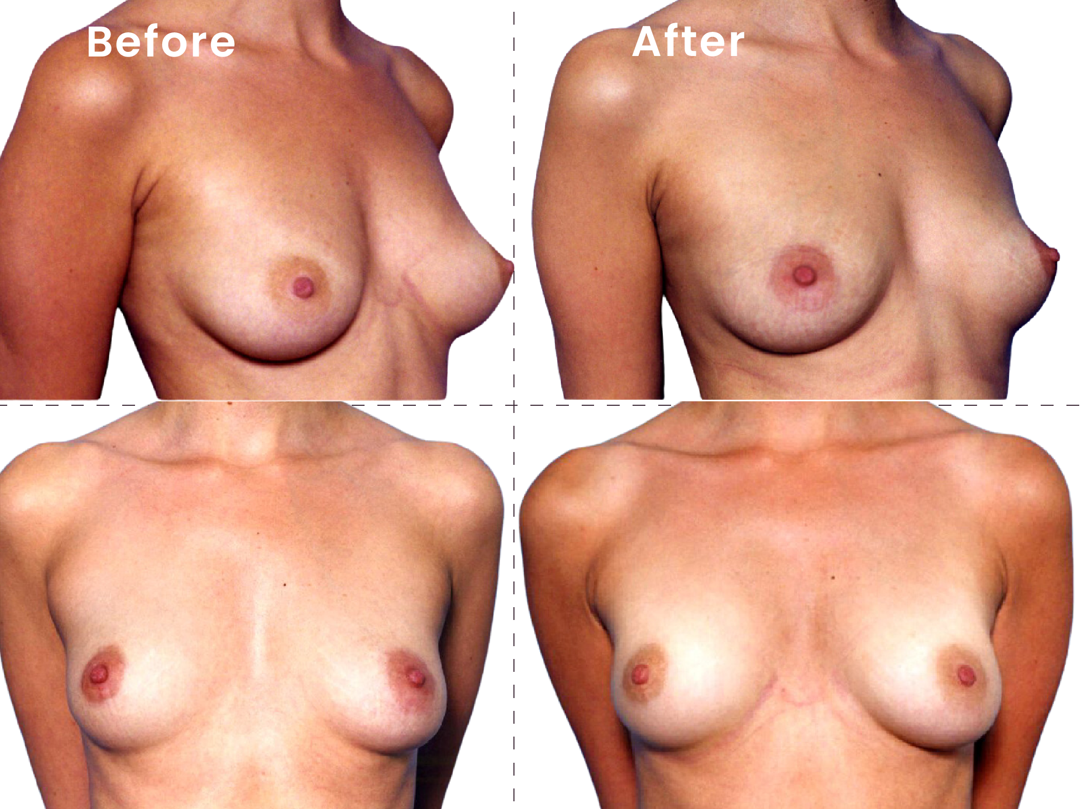 EVEBRA customer result 14 before and after external breast expansion, shown from front and angled views