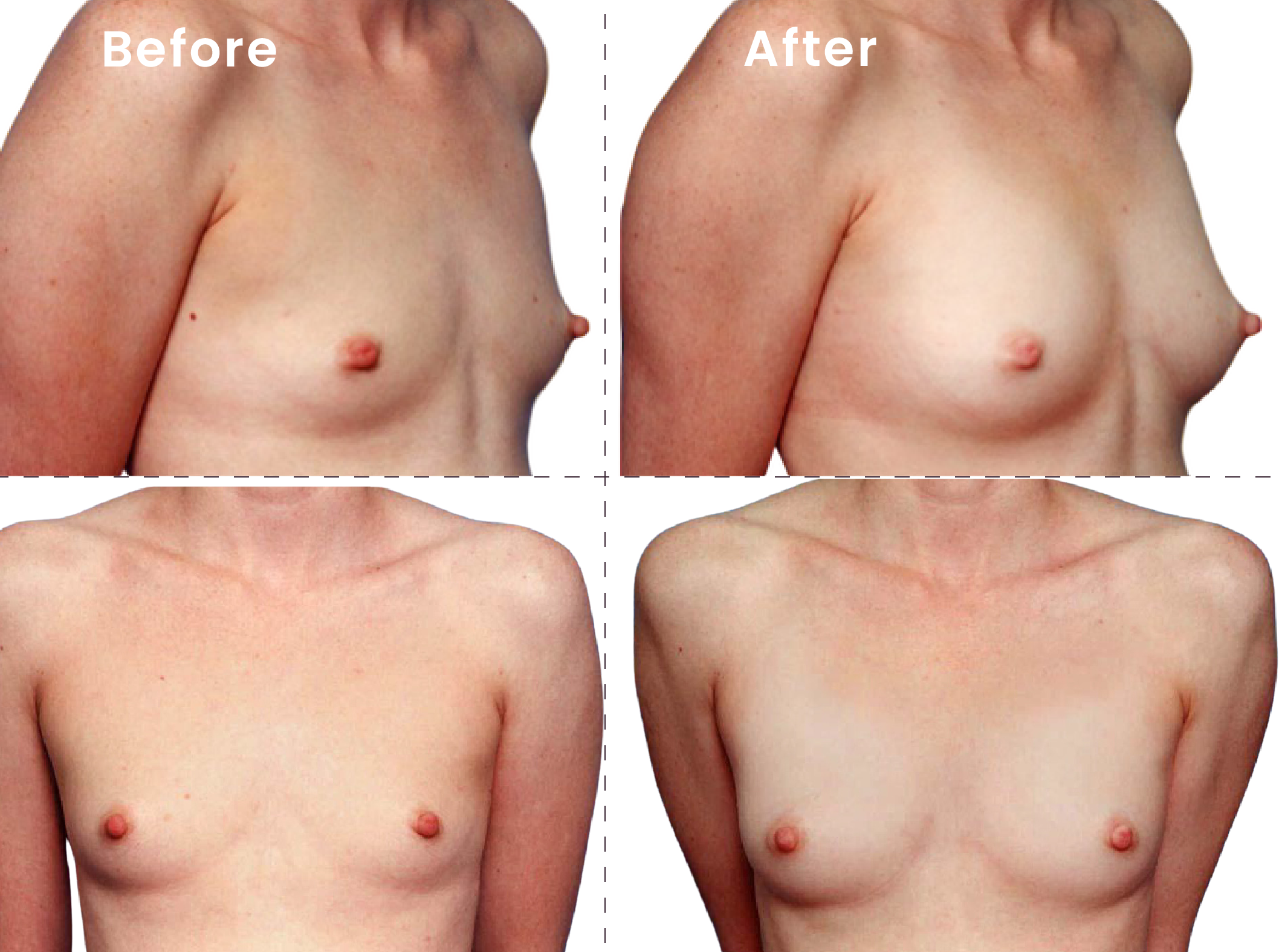 EVEBRA customer result 15 before and after external breast expansion, shown from front and angled views