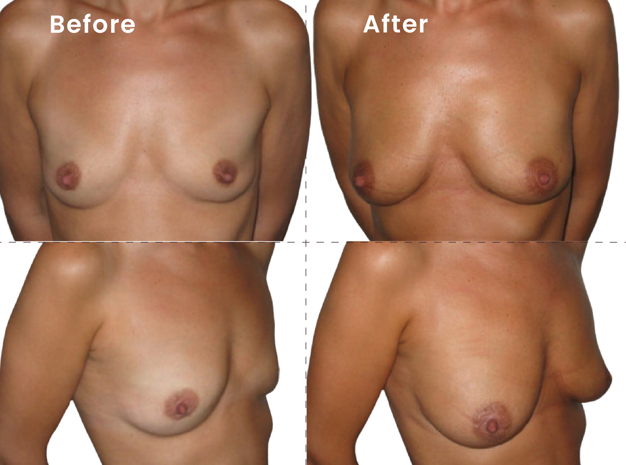 EVEBRA customer result 16 before and after external breast expansion, shown from front and angled views