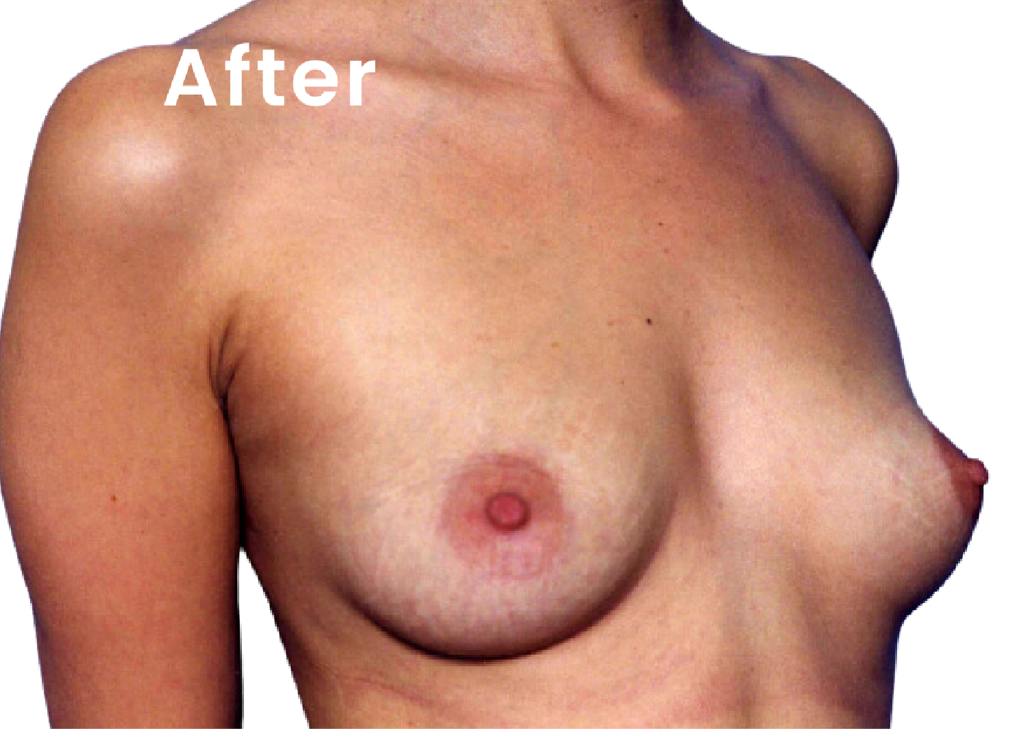The same EVEBRA customer after following an external breast expansion protocol