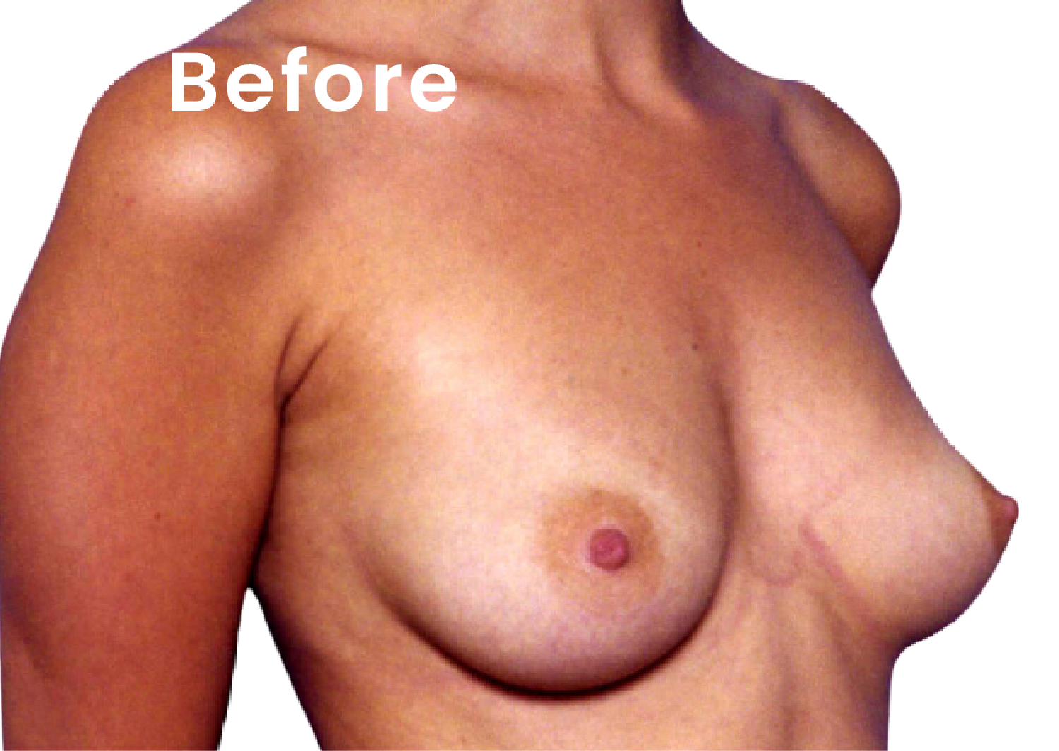 EVEBRA customer before following an external breast expansion protocol