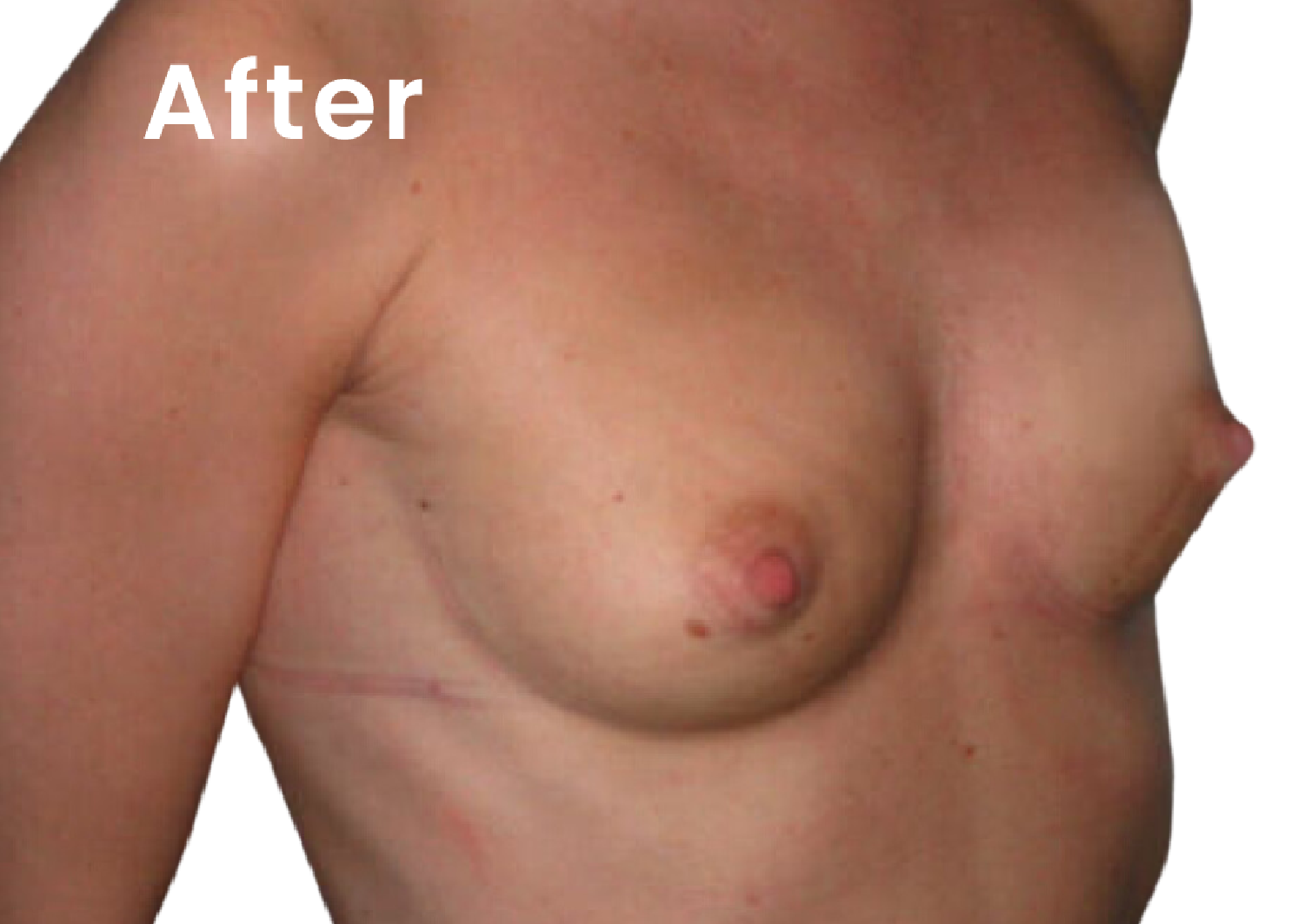 The same EVEBRA customer result 02 after external breast expansion