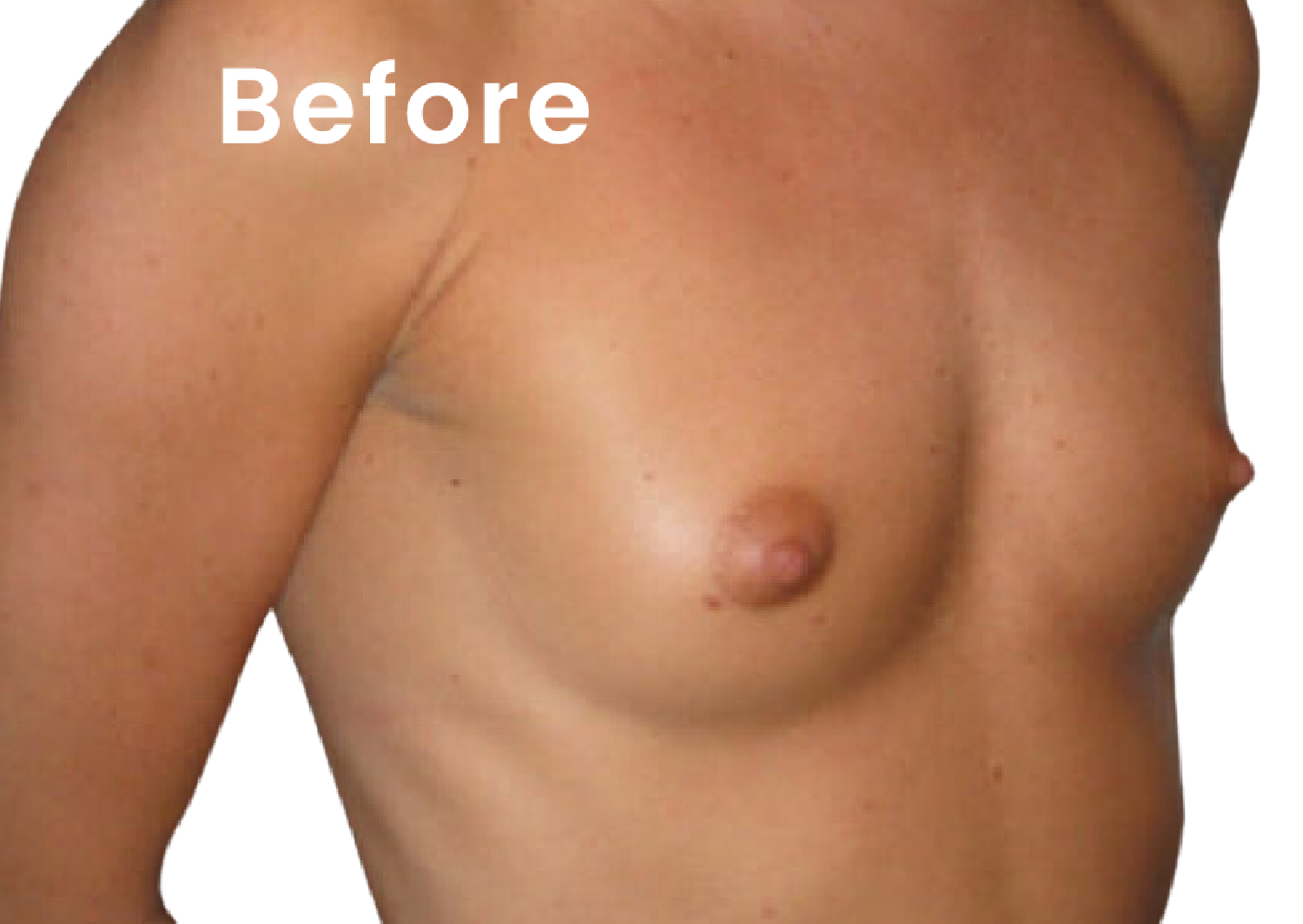 EVEBRA customer result 02 before external breast expansion
