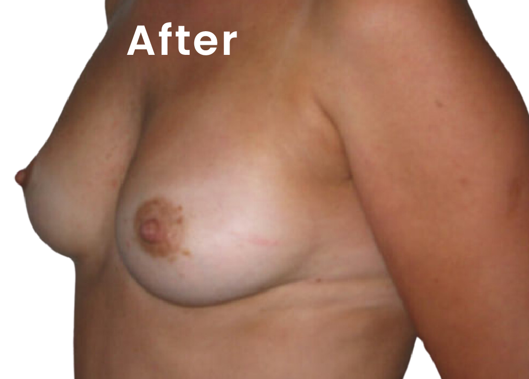 The same EVEBRA customer result 03 after external breast expansion