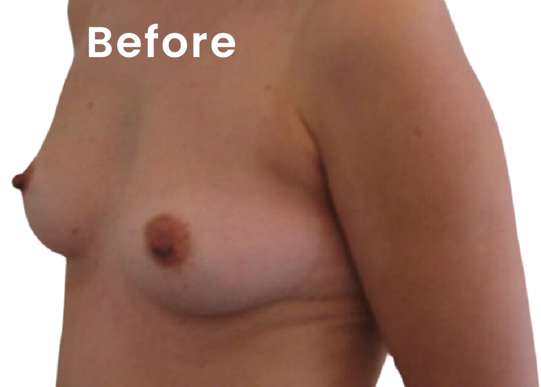 EVEBRA customer result 03 before external breast expansion