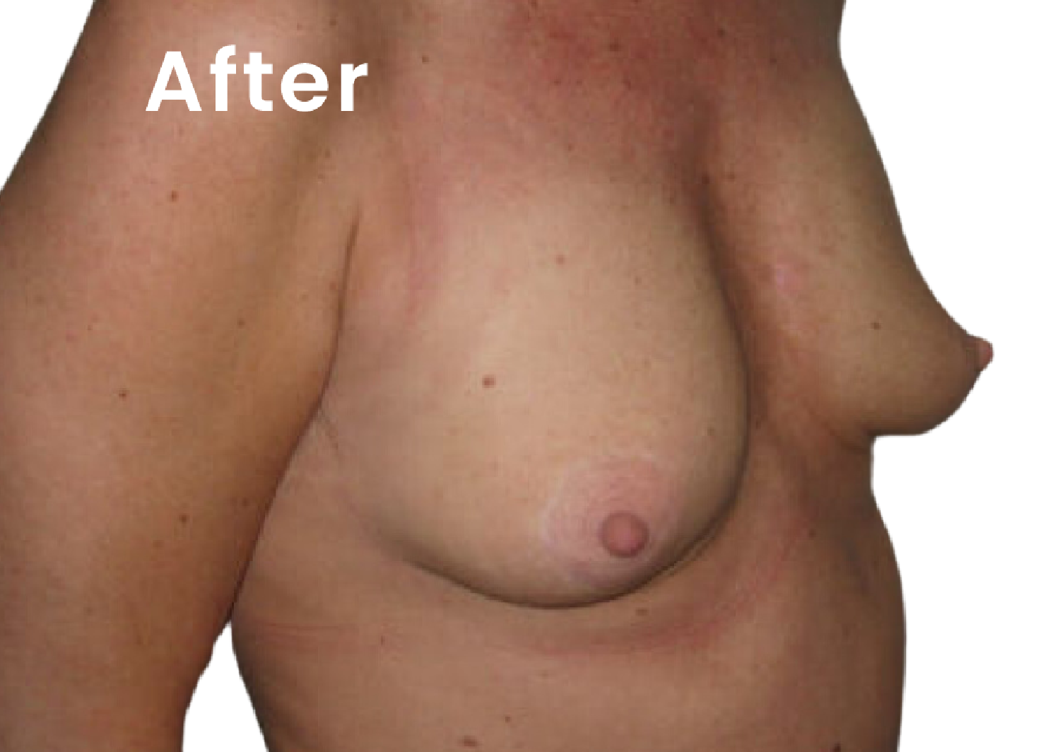 The same EVEBRA customer result 04 after external breast expansion