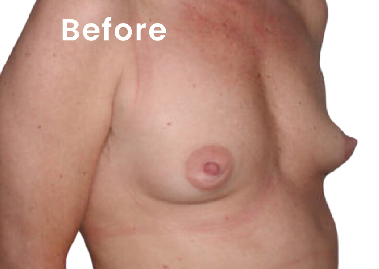EVEBRA customer result 04 before external breast expansion