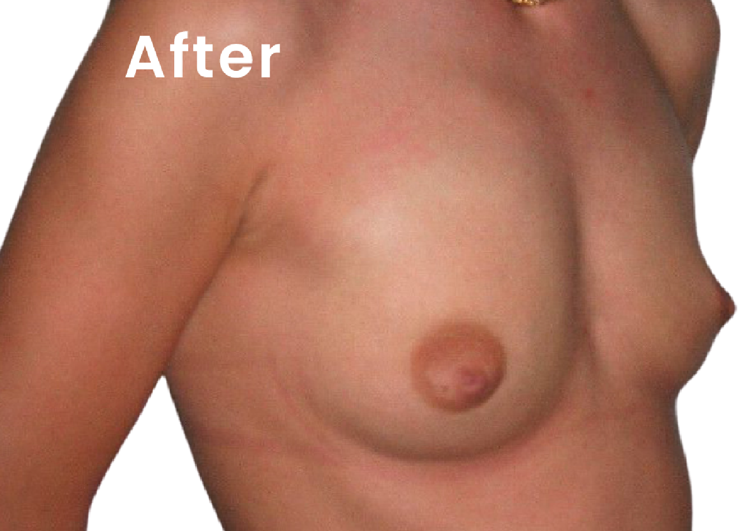 The same EVEBRA customer result 05 after external breast expansion