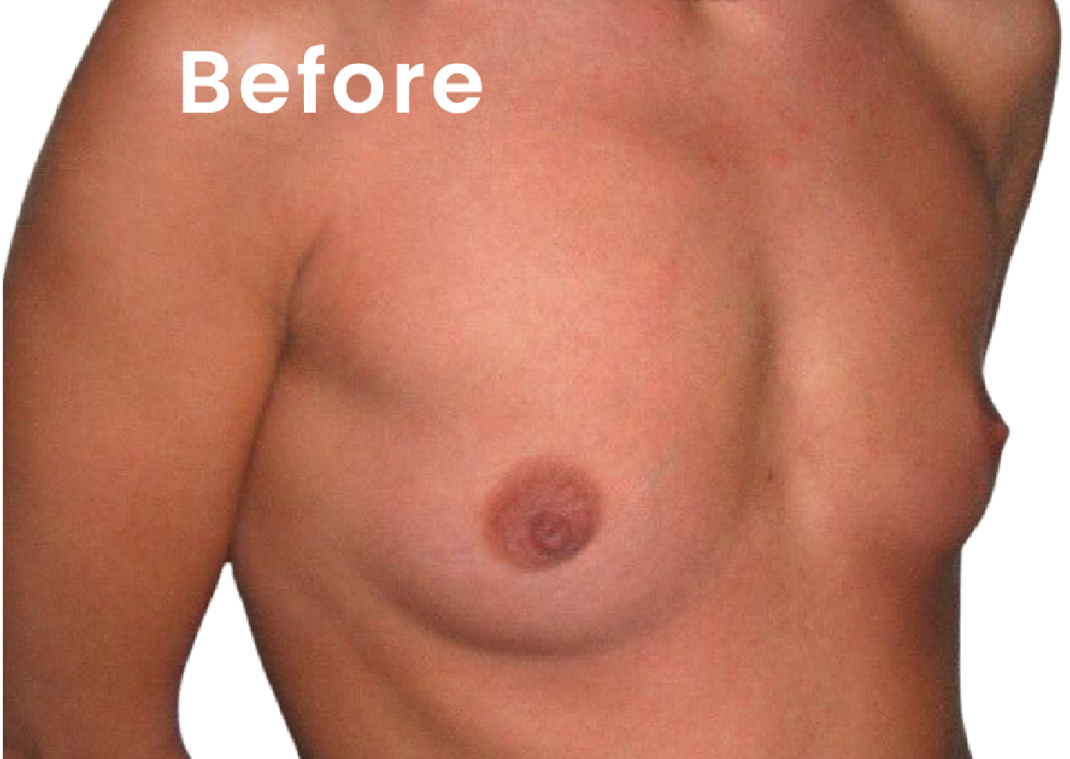 EVEBRA customer result 05 before external breast expansion