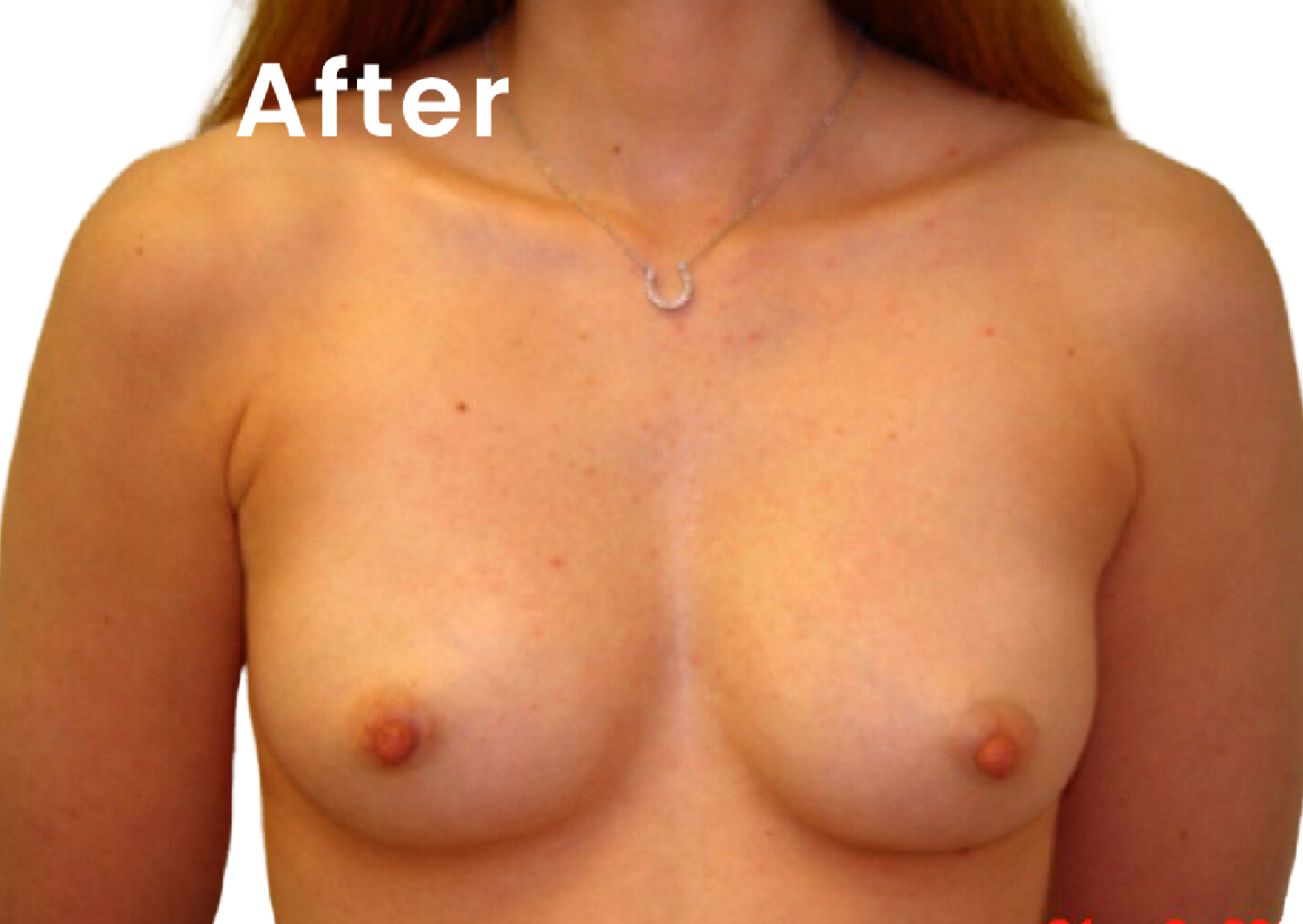 The same EVEBRA customer result 06 after external breast expansion