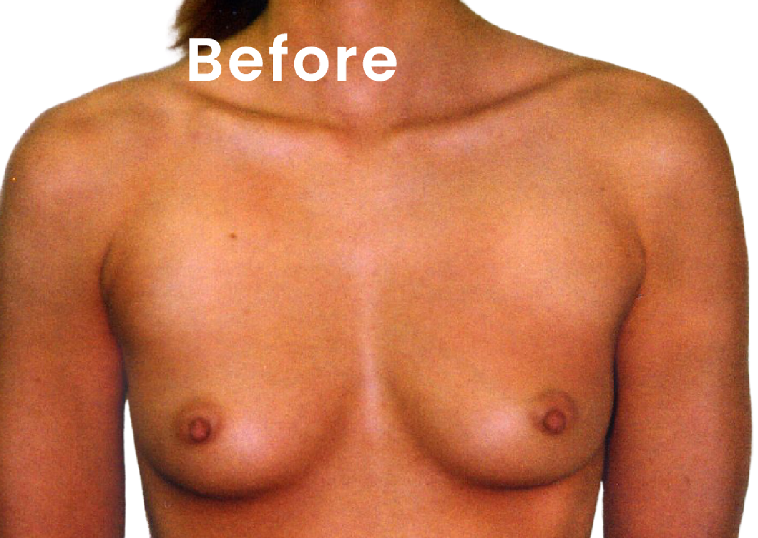 EVEBRA customer result 06 before external breast expansion