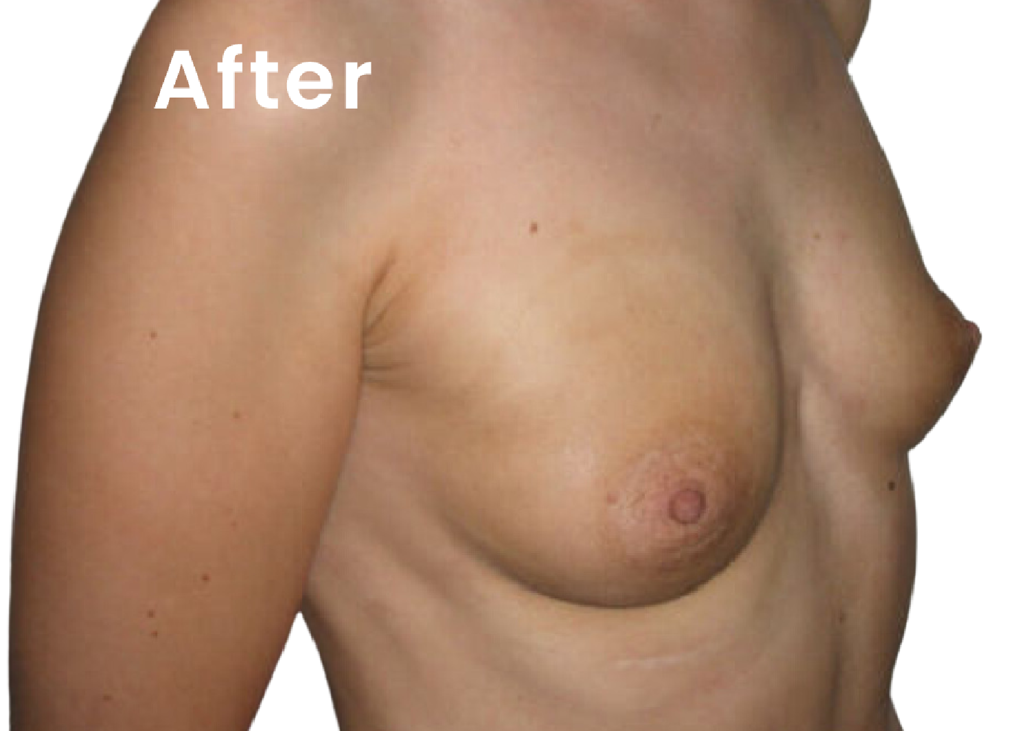 The same EVEBRA customer result 07 after external breast expansion