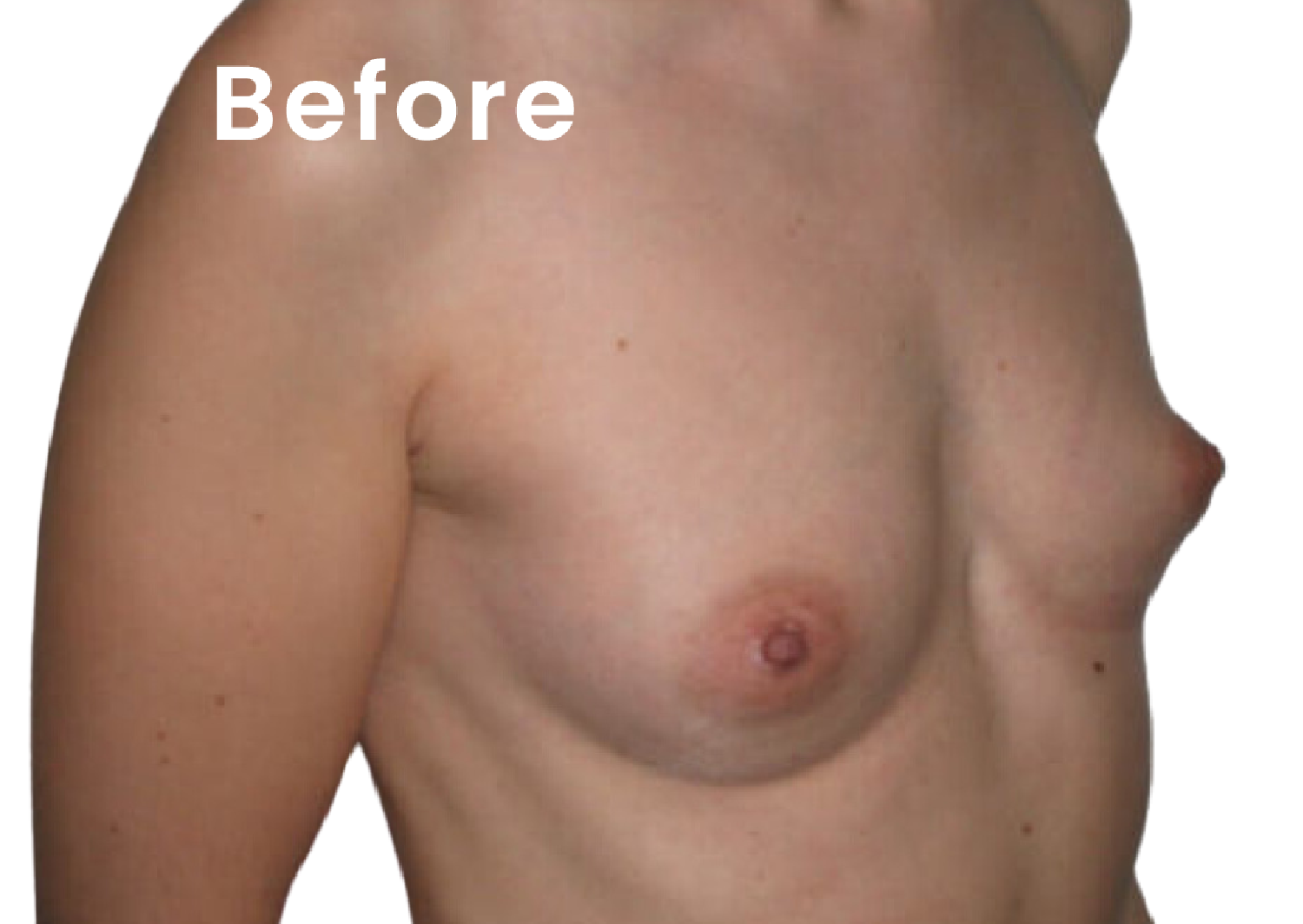 EVEBRA customer result 07 before external breast expansion