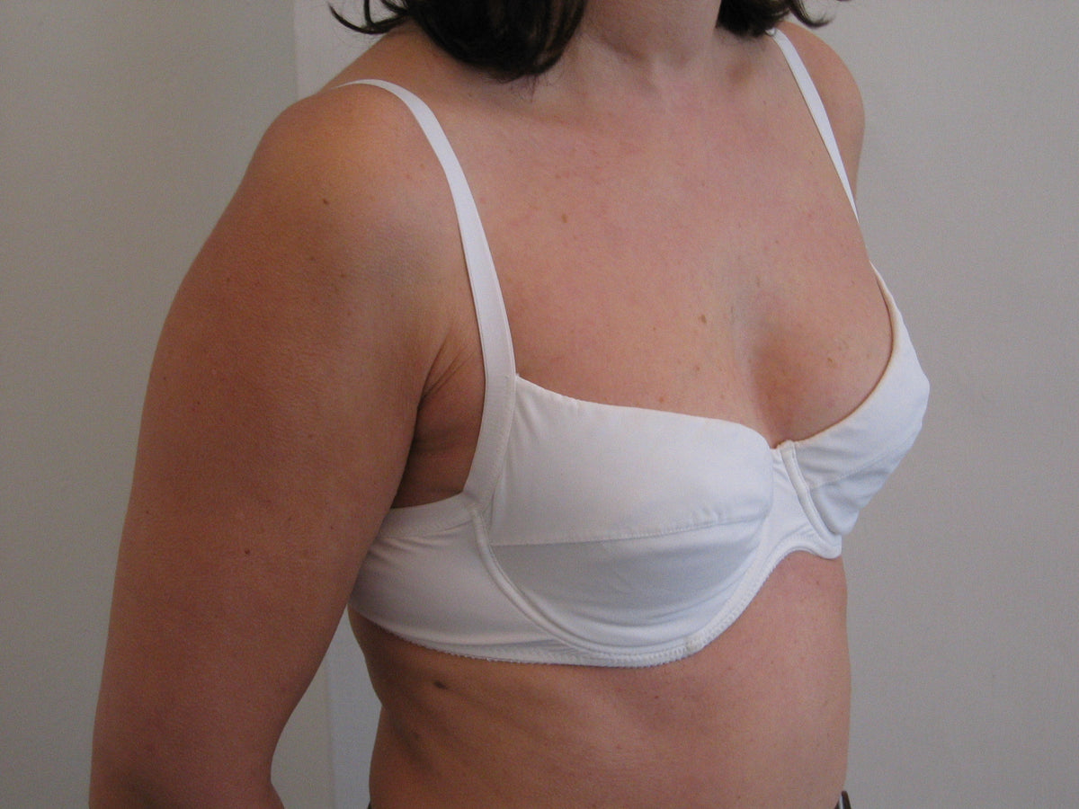 Baseline angled view of the same person in a white bra