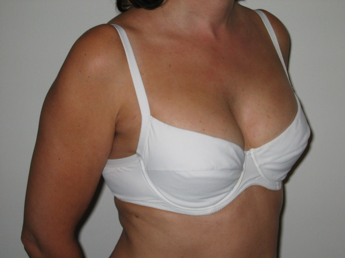 Nine-month follow-up angled view of the same person, following 16 weeks of treatment
