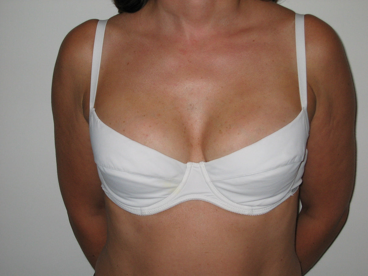Nine-month follow-up front view of the same person, following 16 weeks of treatment